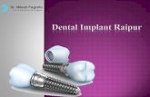 Dental implant raipur