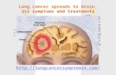 Lung cancer spreads to brain and its symptoms