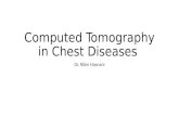 Ct chest pneumonias and neoplasms
