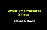 fractures of the lower limb