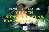 10-minute Operation : Close Reduction with Percutaneous Pinning in Supracondylar Fracture Type III