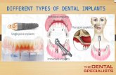 The Top Types of Dental Implants You Need to Know