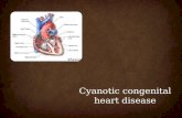 Classification of Congential Heart Diseases and cyanotic heart disease
