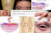 Atopic dermatitis (eczema) kaitlyn bradshaw