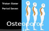 Osteoporosis Tristan Slater Period Seven. So, what is osteoporosis? o Affects the skeletal system o Causes bones to become brittle o Most common bones.