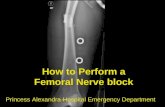 How to Perform a Femoral Nerve block
