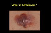 What is Melanoma?. Melanoma is the deadliest form of skin cancer  Melanoma originates in the cells of the skin that make pigment, called melanocytes.