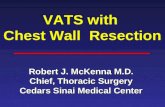 VATS with Chest Wall Resection