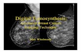 Digital Tomosynthesis - University of California, Santa ...hansmalab.physics.ucsb.edu/phys150/DTS.pdf · Digital Tomosynthesis ... radiology due to the high contrast and resolution