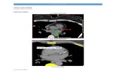 CT Calcium score - Austin Radiological Association Tomography... · Web viewSelect “save word document and images as DICOM series ...