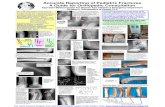 Accurate Reporting of Pediatric Fractures A Guide for ... · PDF fileAccurate Reporting of Pediatric Fractures ... point toward the radial side of the ... Type II supracondylar fracture.