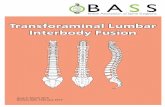 Transforaminal Lumbar Interbody · PDF filepatients only require treatment such as physiotherapy and medication, ... A high-speed burr ... Often the hole or tear in the dura is repaired