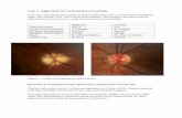 Case 2 - Right Optic Nerve Head Drusen (ONHD)glaucomaeducation.com/assets/gpep/pdf/Case2_Case_and_Questions… · The classic RNFL ‘double hump’ (RNFL thickest superiorly and