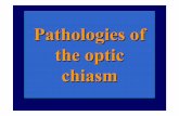 Visual pathways in the chiasm - Home | Fondazione G.B. Bietti · Intracranial relationships of the optic nerve. ... - glioma (7%): astrocytoma ... distance separating the optic chiasm