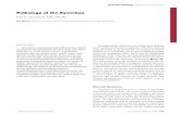 Pathology of the Synovium - Semantic Scholar · Pathology of the Synovium John X. O’Connell, MB, FRCPC ... localized or diffuse nodular thickening of the synovial ... hemosiderotic