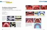 Prothèse télescopique sur barre fraisée 17 Dr METZ copie.pdf · L’impact des dents antagonistes est visible en antérieur, et les faces occlusales des dents ... Le choix de la