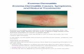 Eczema Dermatitis Eczema Dermatitis Causes ... - Dermatitis Causes...  Eczema Dermatitis 1 Eczema