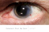 Cataract Post Op Care - ncascade.com · Routine Cataract Surgery • Risks • Dry eye • Endophthalmitis • Toxic Anterior Segment Syndrome (TASS) • Cystoid Macular Edema •