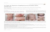 A Case of Abortive Staphylococcal Scalded Skin Syndrome · Brief Report 624 Ann Dermatol Received August 14, 2017, Revised October 10, 2017, Accepted for publication October 19, 2017