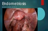 Endometriosis - sjhsyr.org · Prevalence of endometriosis ranges from 1-7% of population ... Very accurate in detecting endometrioma’s >2 cm and adenomyosis . Diagnosis: Imaging