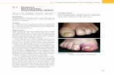 3.1 Diabetic Neuropathic Onychopathy (DNO) · Wound status Wagner 0-5 y 0 No open lesions; may have deformity or cellulitis y 1 Superficial diabetic ulcer (partial or full thickness)