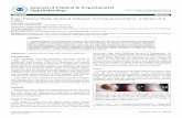 The Journal of Clinical & Experimental after nd sitting of ... · pyogenic granuloma, pseudopterygium and limbal stem cell deficiency. We report a novel non-surgical, Fugo blade assisted