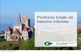 Prothèse totale de hanche infectée - ClubOrtho.fr · 2011-07-04 · 0–3