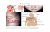 LUPUS - Imune · Lupus is a chronic autoimmune disease wherein the body’s immune system mistakenly attacks healthy body organs and tissue. With lupus this may be in the joints,