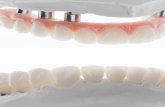 QDT 2016 - SMILE DESIGN · 86 QDT 2016 Framework Design A silicone matrix was made of the incisal edges of the anterior teeth to control the cutback of framework design (Fig 10).