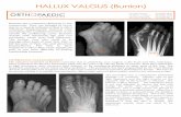 Hallux Valgus 2017 - mos.org.au · HALLUX VALGUS (Bunion) Before After After After Before POST-OPERATIVE MANAGEMENT Immediate weight bearing is possible in a post-operative stiff