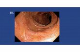 15. - Monster Headphonesentire colon needs endoscopic evaluation to look for mimickers, ie. cancer/polyps • Preventing future episodes: • Surgical resection of diseased segment