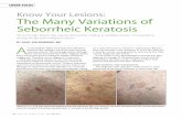 Know Your Lesions: The Many Variations of Seborrheic …The Many Variations of Seborrheic Keratosis SKs are benign lesions that may be removed for medical or aesthetic reasons. It’s