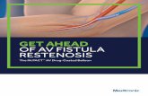 GET AHEAD OF AV FISTULA RESTENOSISThe IN.PACT™ AV DCB has been demonstrated superior to PTA in increasing patency and prolonging time between interventions.1 In separate IN.PACT