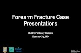 Forearm Fracture Case Presentations · 2019-05-15 · •13y 6 mo old pre-menarchal female did a cartwheel in the street and sustained a midshaft radius and ulna fracture. She is