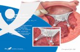 CHORD-XTM ePTFE Suture - SofMedica · 2017-07-31 · • Nonabsorbable polytetrafluoroethylene (ePTFE) suture for chordae tendineae replacement or repair • Two needle choices •