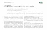 Case Report Retroperitoneal Bronchogenic Cyst: MRI Findingsdownloads.hindawi.com/journals/crira/2013/853795.pdf · 2019-07-31 · Retroperitoneal bronchogenic cyst is a very rare