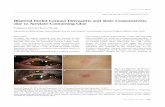 Bilateral Eyelid Contact Dermatitis and Toxic Conjunctivitis due to Acrylate … · 2014-08-12 · acrylate, and propylene glycol. The positive results of pat-ch testing with ethyl