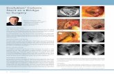 Evolution Colonic Stent as a Bridge to Surgery...Evolution® Colonic Stent as a Bridge to Surgery Indication for Procedure The laparoscopic resection of colorectal carcinomas are,