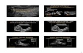 Digital Ultrasound Evaluationjeffline.jefferson.edu/jurei/Limited_OB_0617/Work Folder... · 2016-12-15 · Myometrial Thickness ≤ 1.5 cm Cervical length > 5 – 5.5cm “S” shaped