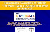 “The Many Types of Arthritis that affect our Patients!” EVANS 2018...Gouty Arthritis Acute Monoarticular Gout (3-10 days) Quick onset Severe crushing pain Affected joint (usually