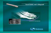 TenFUSE PIP Allograft - Wright Medical Group · TenFUSE PIP Allograft with the Forceps remaining in-place until the middle phalanx is partially reduced. Apply slow steady pressure