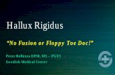 Hallux Rigidus - MemberClicks · • Excision dorsal 20-30% of the metatarsal head • Remove lateral exostosis ... • There was no correlation of hallux rigidus with an elevated