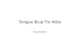 Tongue &Lip Tie Atlas...Tongue Tie: the presentations vary by classifications for anterior, posterior and a “controversial” deep or submucosal This is a Normal Tongue presentationTongue
