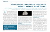 Porcelain laminate veneers. What, when and how? · of porcelain to an etched enamel surface. The porcelain veneer itself is a thin shell of porcelain (Figure 1) which has relatively