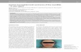 Central mucoepidermoid carcinoma of the mandible …srpskiarhiv.rs/global/pdf/articles-2016/septembar...532 doi: 10.2298/SARH1610531K Krasić D. et al. Central mucoepidermoid carcinoma