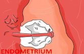 endometrium - PMA endometrial microbiota .Caused by continuing inflammation of endometrial mucosa. Endometriosis
