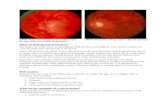 diseases/Retinal Vein Oc… · Web viewIntravitreal Injection of Ozurdex (a long lasting Dexamethasone tablet) Focal Laser therapy Pan-retinal photocoagulation therapy It is also