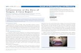Schwannoma at the Base of Tongue: A Case Report€¦ · Malignant change does almost never ... , snoring, voice change and otalgia. The differential diagnosis of a lesion in the base