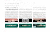 La técnica Monoblock – ¿una revolución en la odontología …€¦ · diente 3, 10, 17. a lo largo de toda la superfi-cie limítrofe. La utilización de pernos ra-diculares no-metálicos