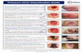 Pressure Ulcer Classification Guide reducing avoidable harms 1 · Pressure Ulcer Classification Guide Category/Stage II: Partial Thickness Skin Loss Partial thickness loss of dermis